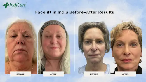 Facelift in India Before-After Results